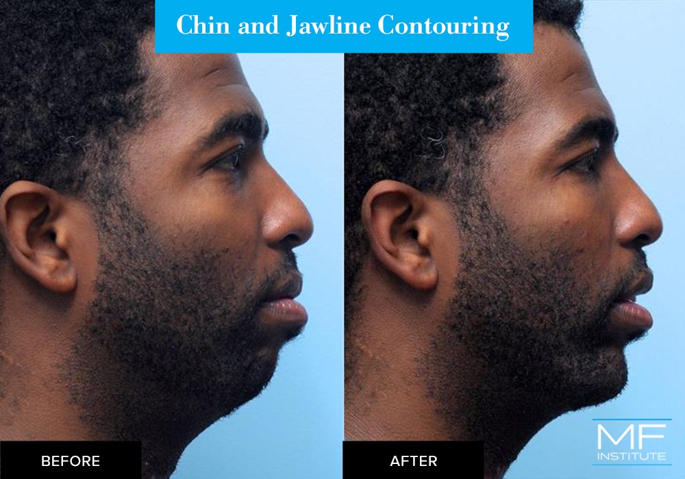 Nonsurgical chin and jawline contouring before and after case from Mabrie Facial Institute in San Francisco (case #302)