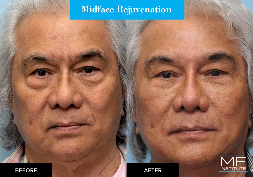 Midface rejuvenation, before and after case from Mabrie Facial Institute in San Francisco (case #348)