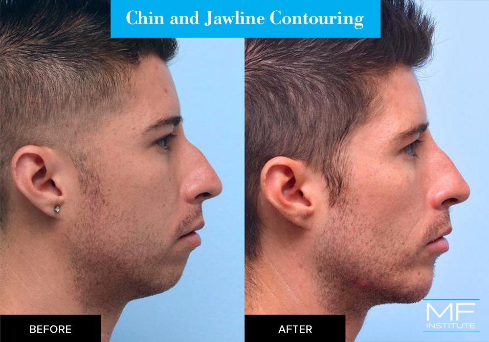 Nonsurgical chin and jawline contouring before and after case from Mabrie Facial Institute in San Francisco (case #496)