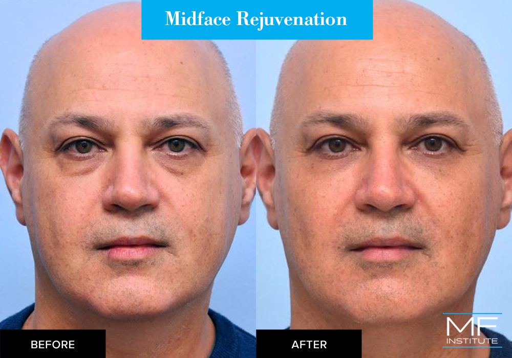 Midface rejuvenation, before and after case from Mabrie Facial Institute in San Francisco (case #520)