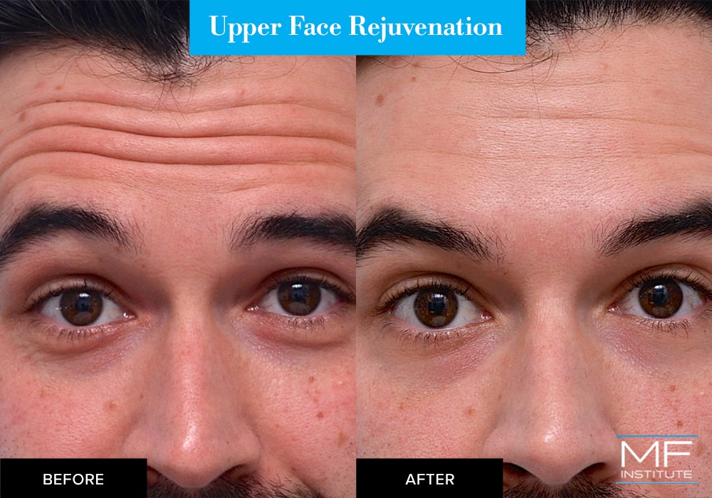 Nonsurgical upper face rejuvenation before and after case from Mabrie Facial Institute in San Francisco (case #629)