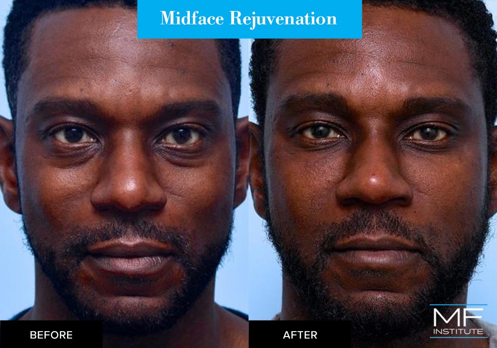 Midface rejuvenation, before and after case from Mabrie Facial Institute in San Francisco (case #651)