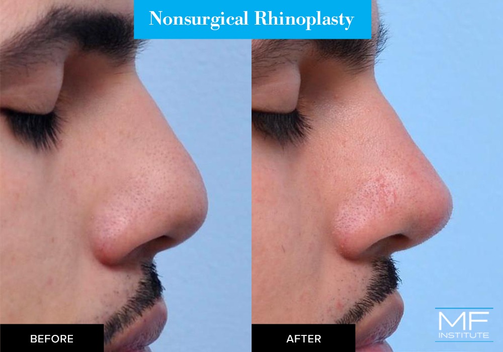 Nonsurgical rhinoplasty before and after case from Mabrie Facial Institute in San Francisco (case #653)