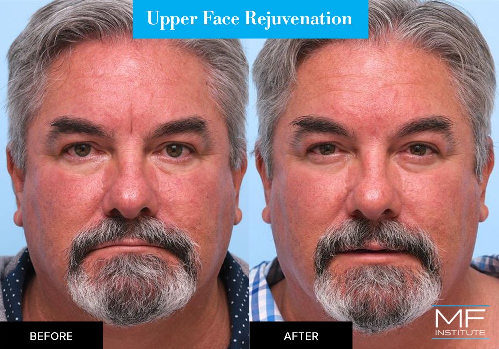 Nonsurgical upper face rejuvenation before and after case from Mabrie Facial Institute in San Francisco (case #655)
