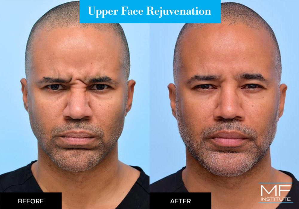 Nonsurgical upper face rejuvenation before and after case from Mabrie Facial Institute in San Francisco (case #657)