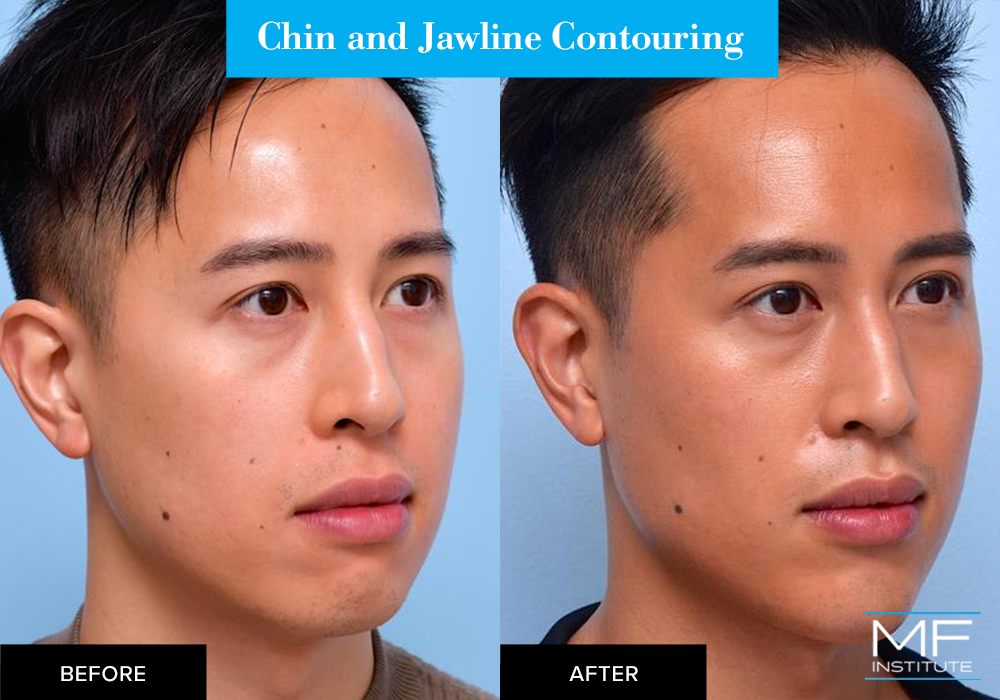 Nonsurgical chin and jawline contouring before and after case from Mabrie Facial Institute in San Francisco (case #659)