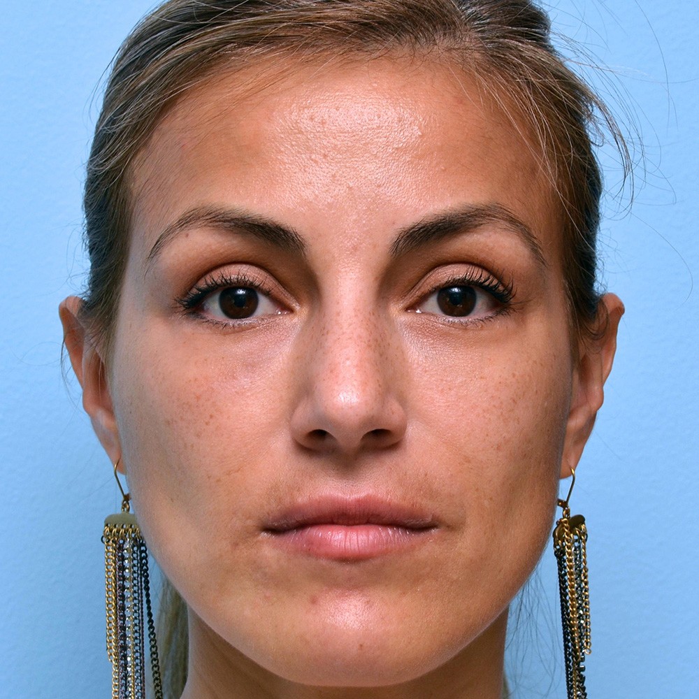 Patient after her third filler treatment