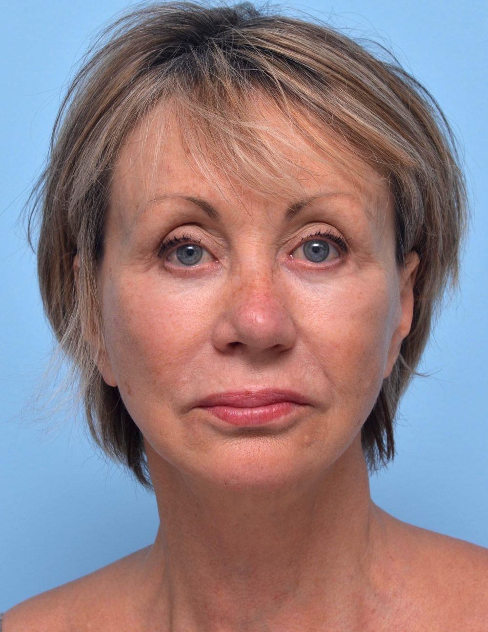 after reducing nasolabial folds with botox