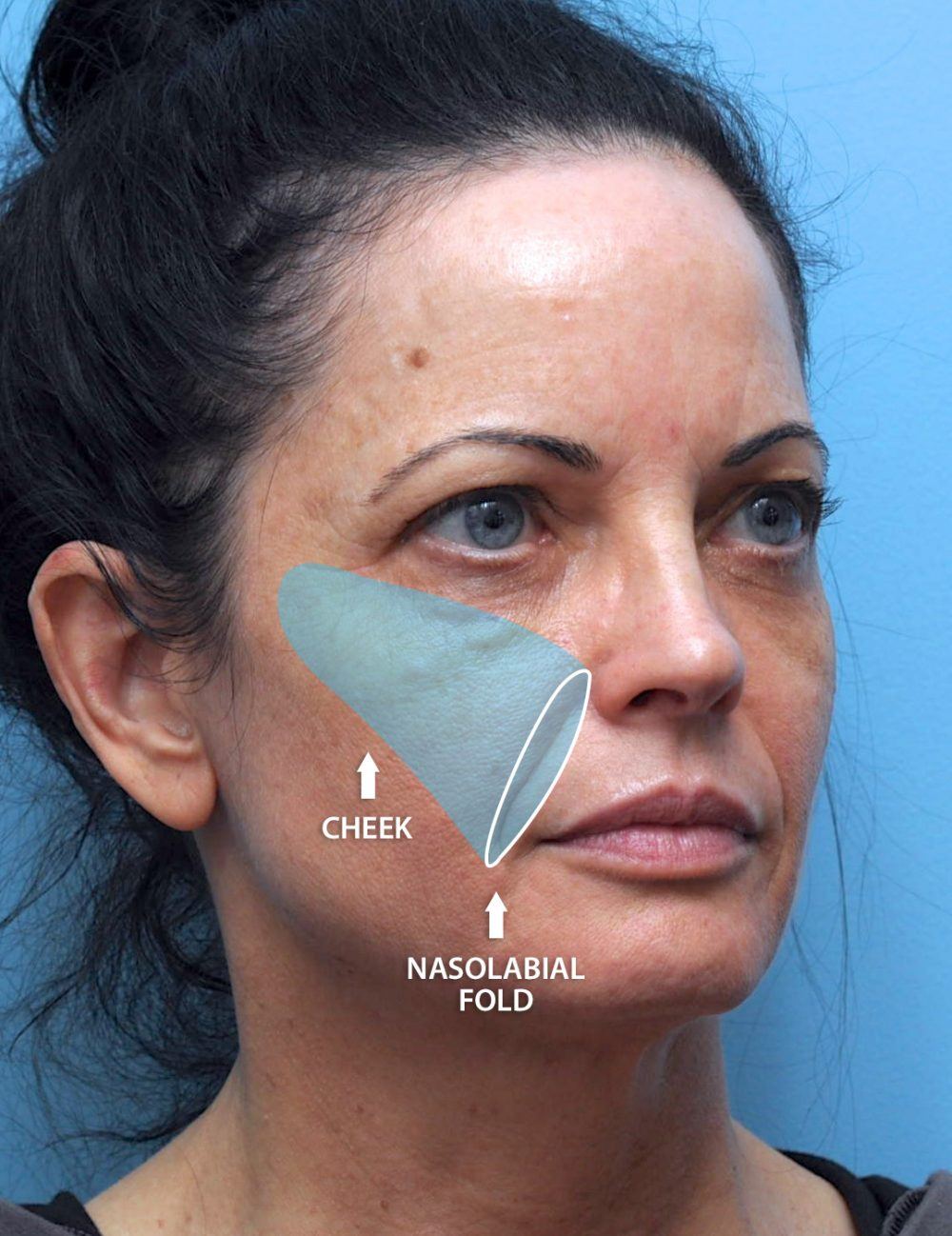 Diagram showing the nasolabial folds on a  female patient of Mabrie Facial Institute in San Francisco