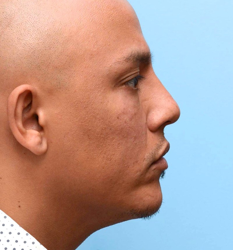 After midface rejuvenation profile view