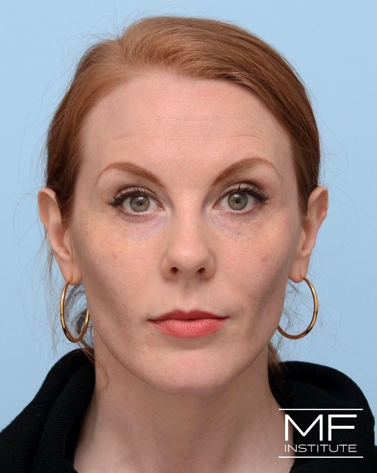 After Illumination 360˚  Midface Rejuvenation for under-eye circles and nonsurgical rhinoplasty