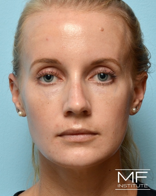 After cheek restoration through Juvederm Voluma and Restylane