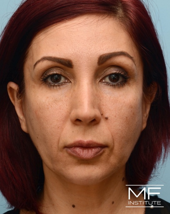 After nasolabial folds treatment with dermal fillers.