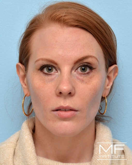 Before Illumination 360˚  Midface Rejuvenation for under-eye circles and nonsurgical rhinoplasty