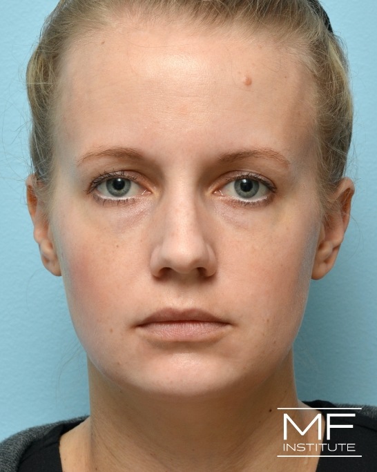 Before cheek restoration through Juvederm Voluma and Restylane