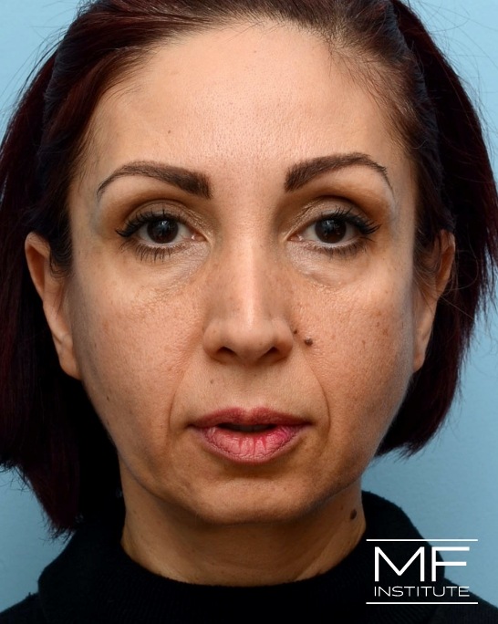 Before nasolabial folds treatment with dermal fillers.