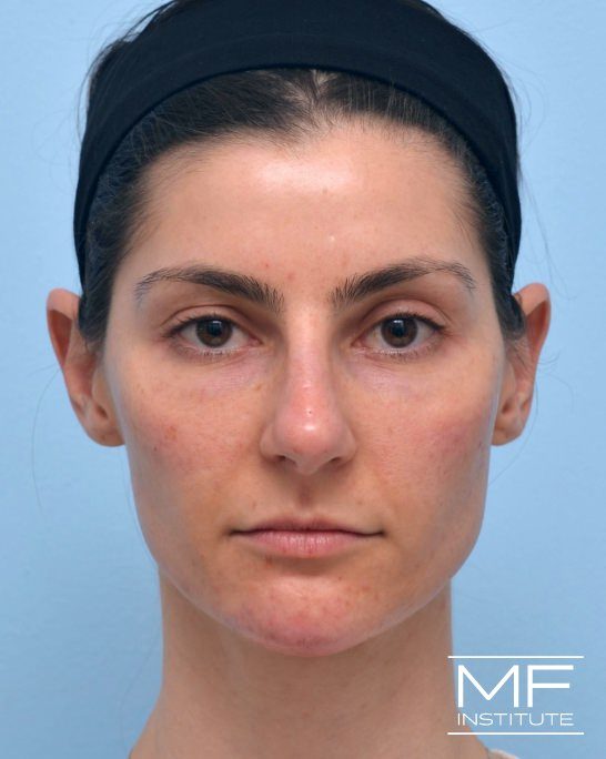 After female nonsurgical facelift