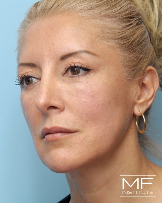 After female nonsurgical facelift