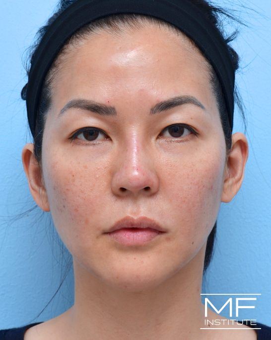 After female nonsurgical facelift