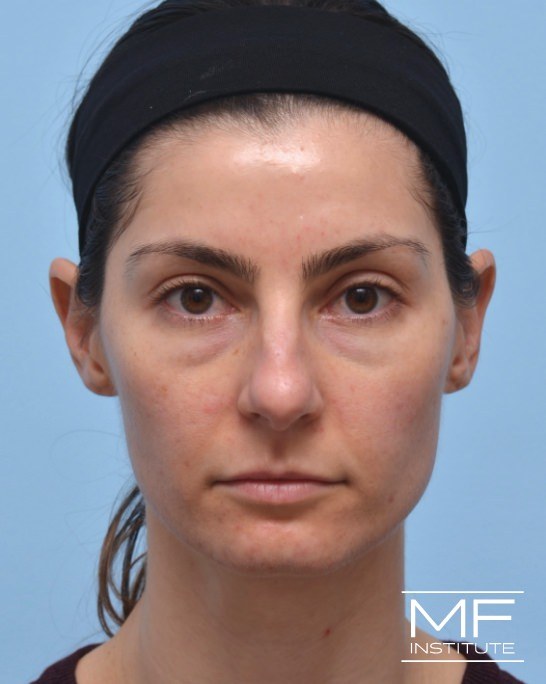 Before female nonsurgical facelift
