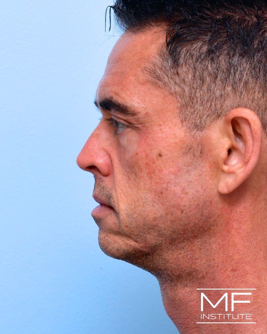 Before male side view of nonsurgical facelift