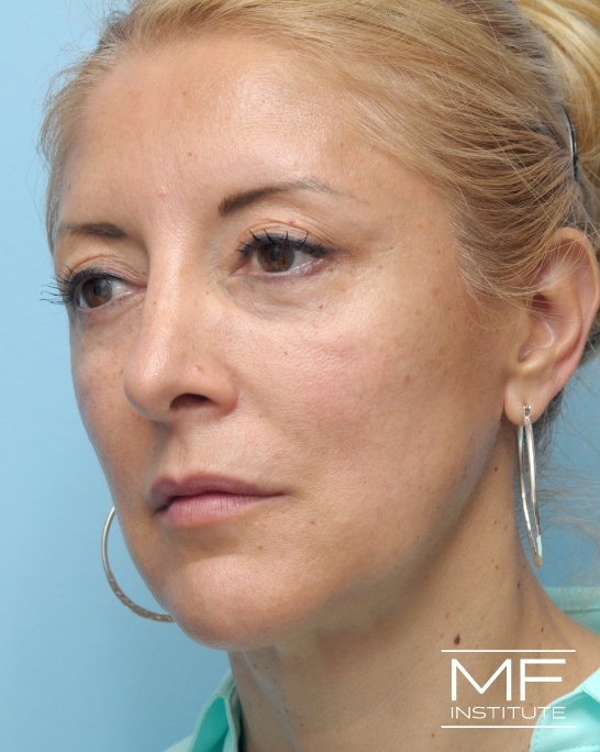 Before female nonsurgical facelift