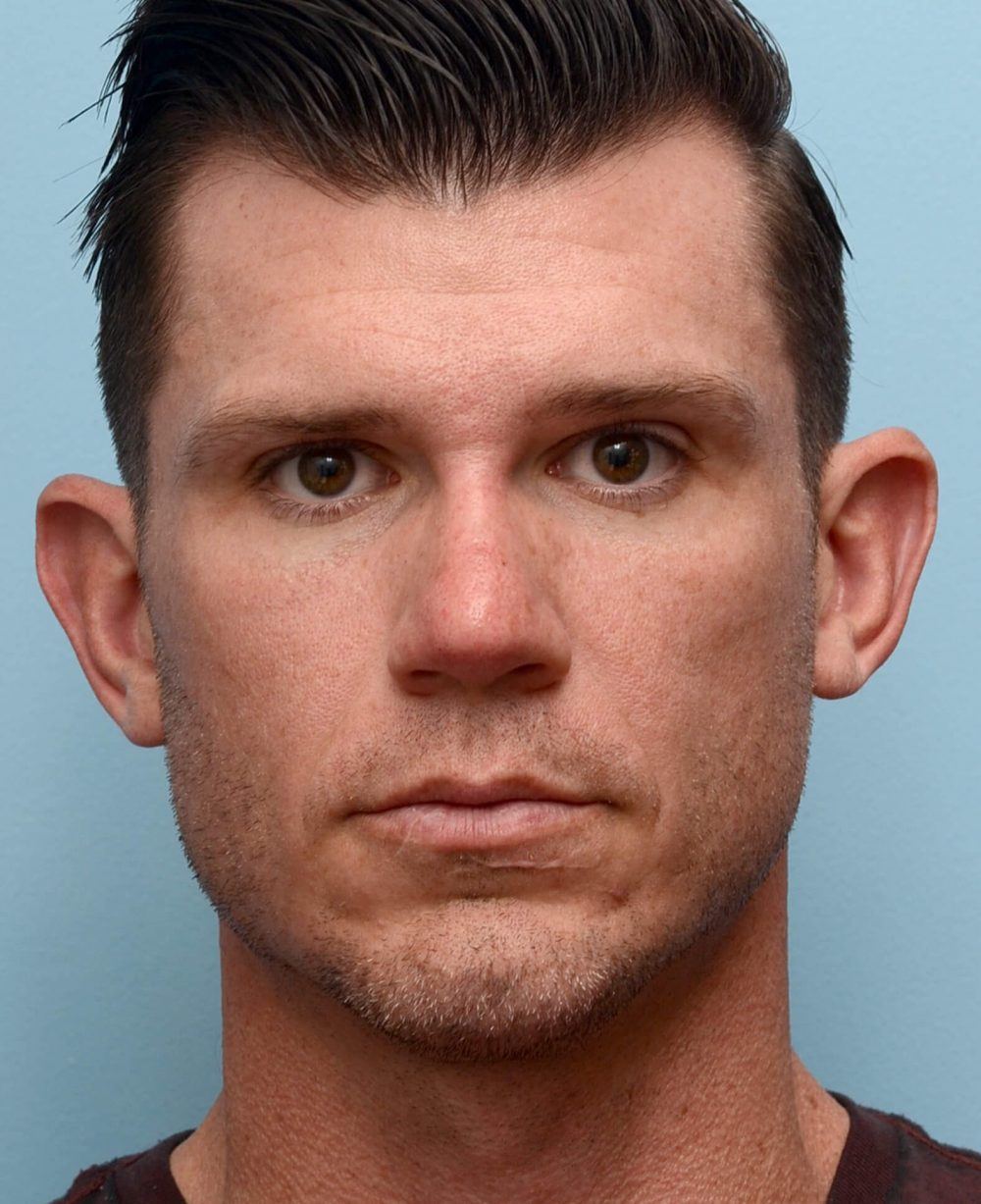 athletic-shaped face after procedure