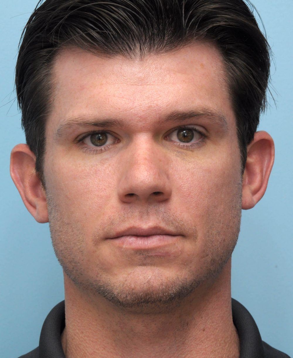 athletic-shaped face before procedure