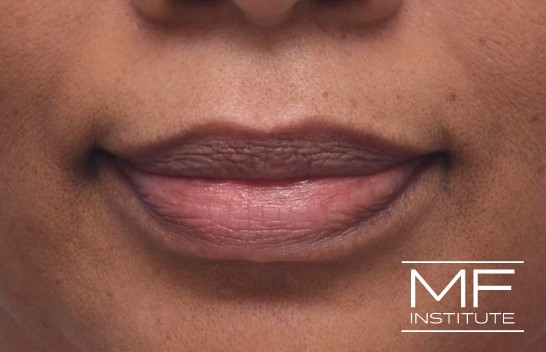 Smooth Lips: Singapore's Topical Treatments for Lip Wrinkles