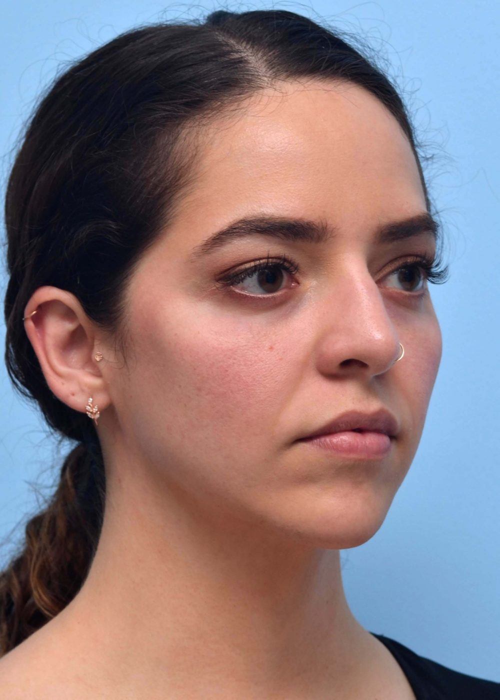heart-shaped face after procedure