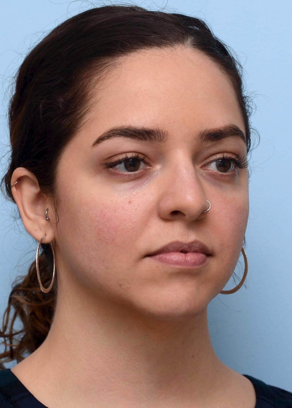 heart-shaped face before procedure