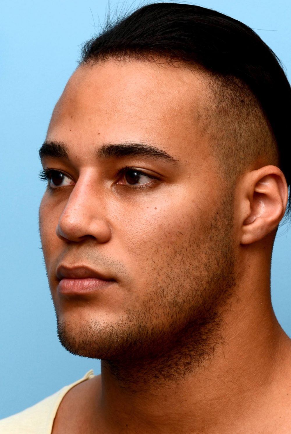 oval-shaped face after procedure