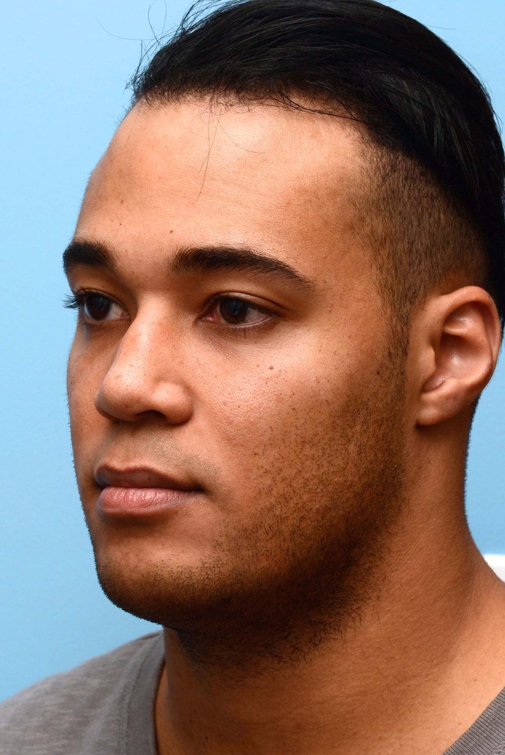 oval-shaped face before procedure