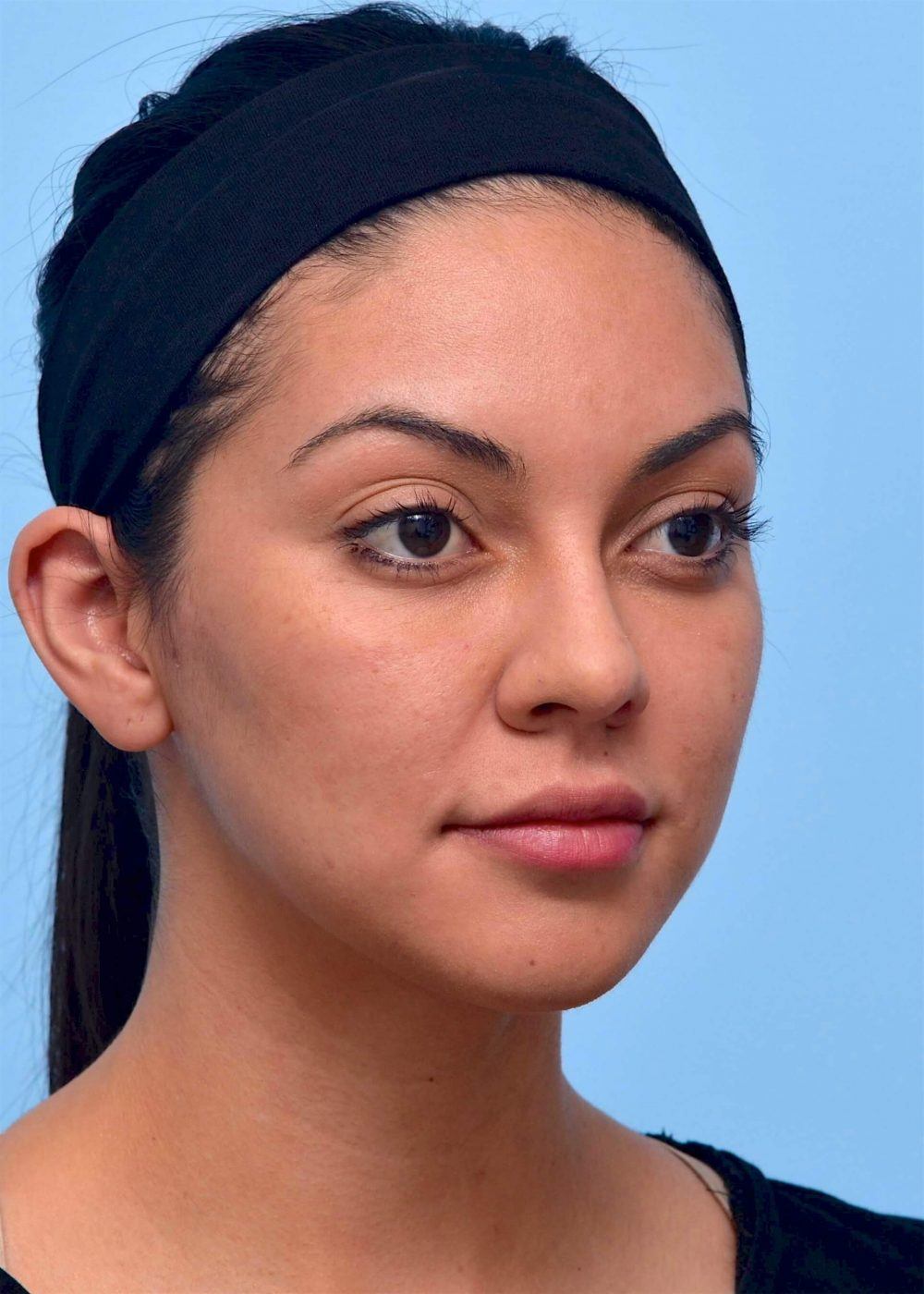 round-shaped face after procedure