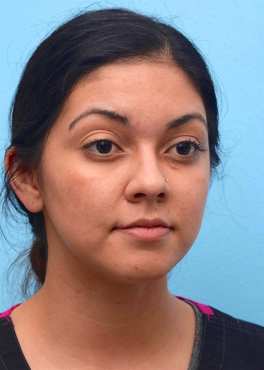 round-shaped face before procedure