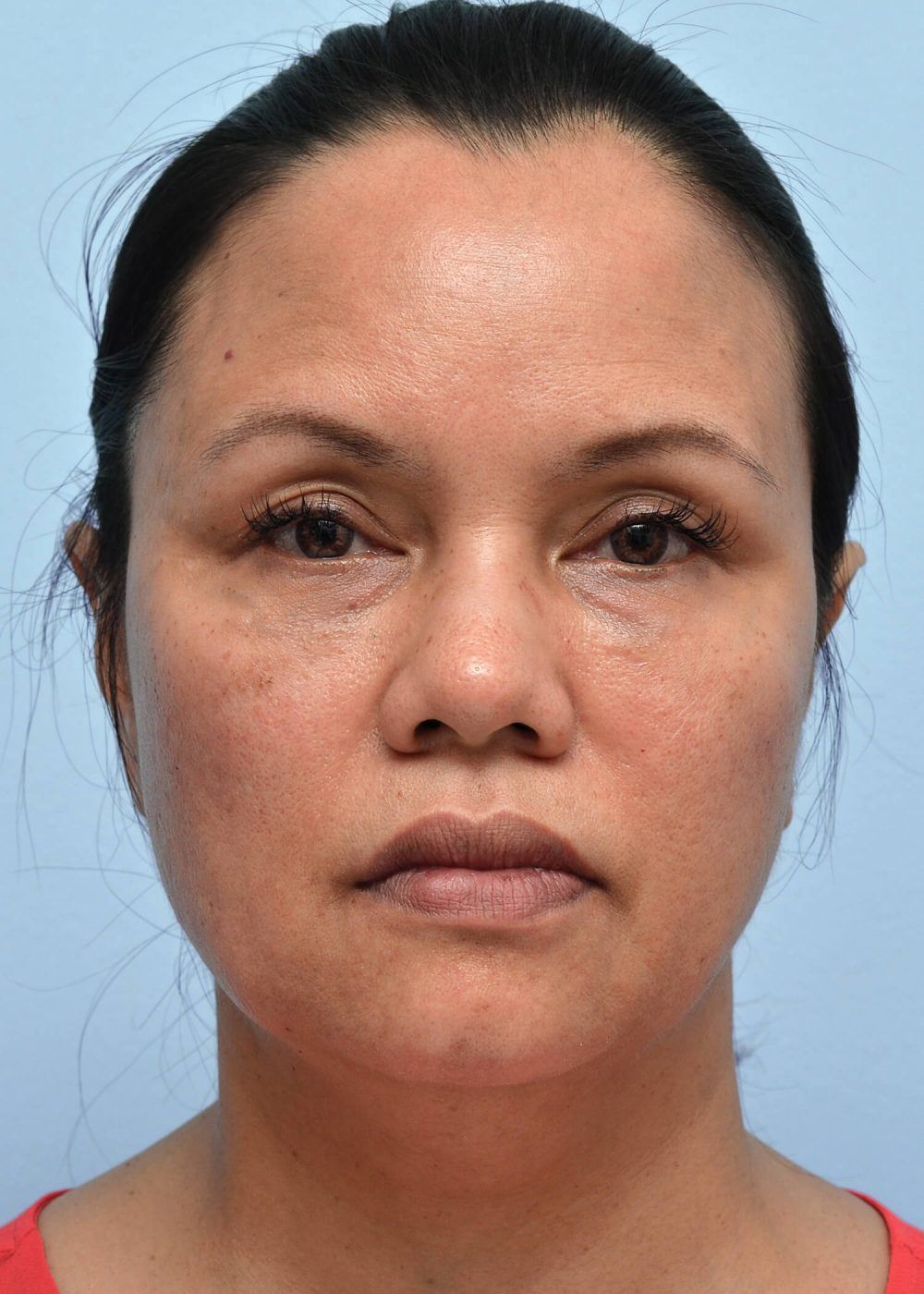 square-shaped face after procedure