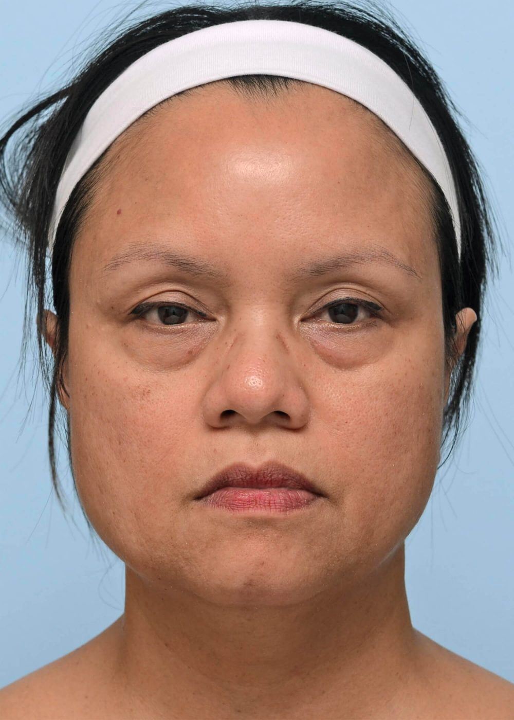 square-shaped face before procedure