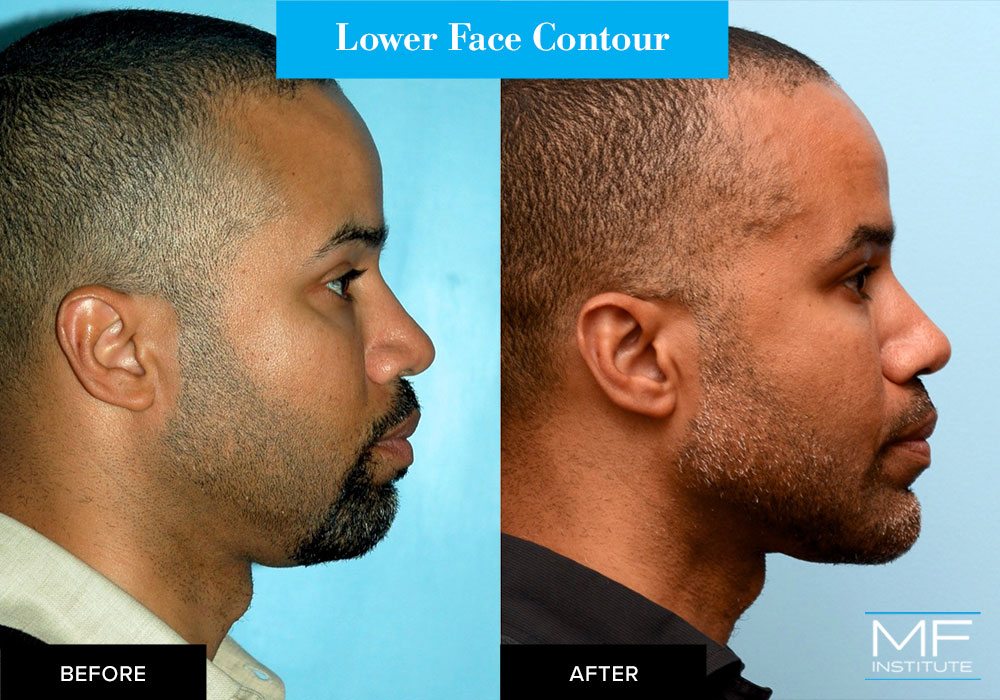 side profile of male before and after lower face contour