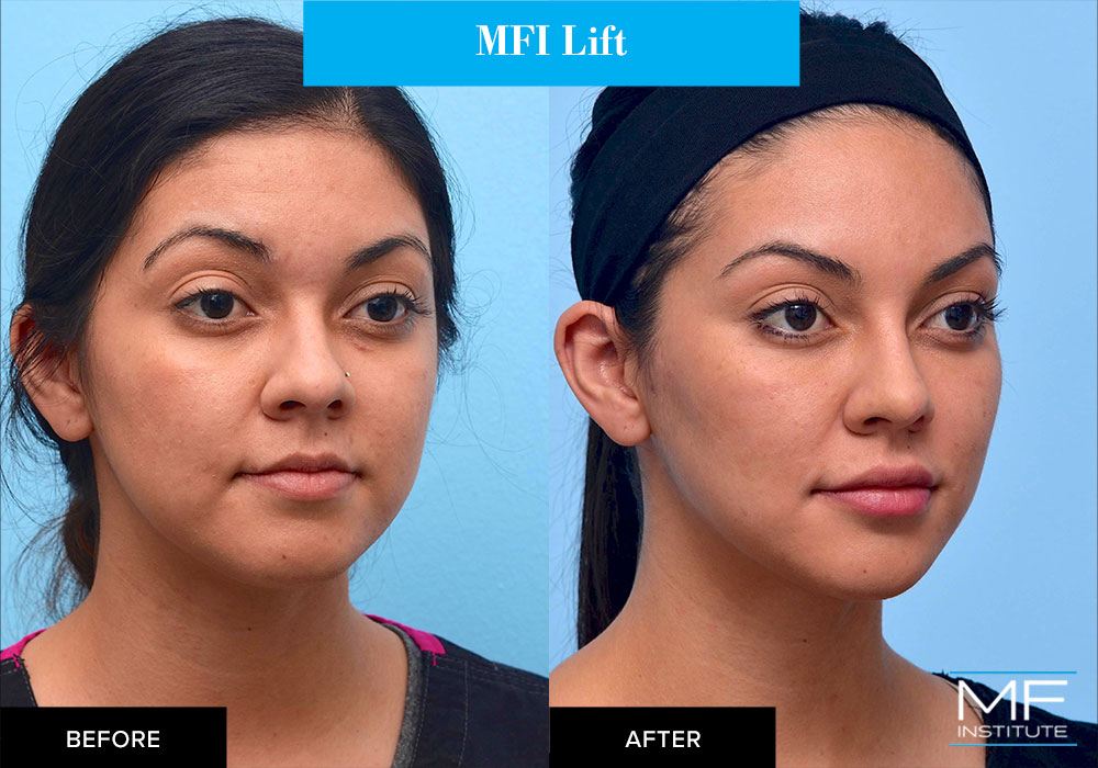 mfi lift before and after on woman
