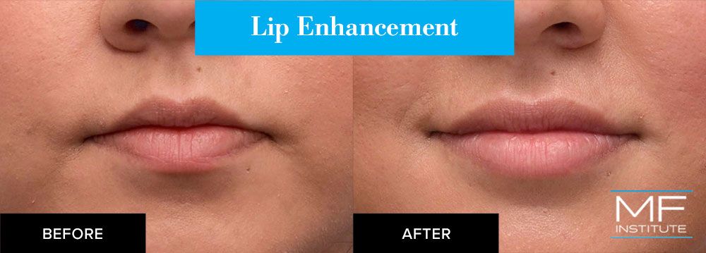 lips before and after lip enhancement