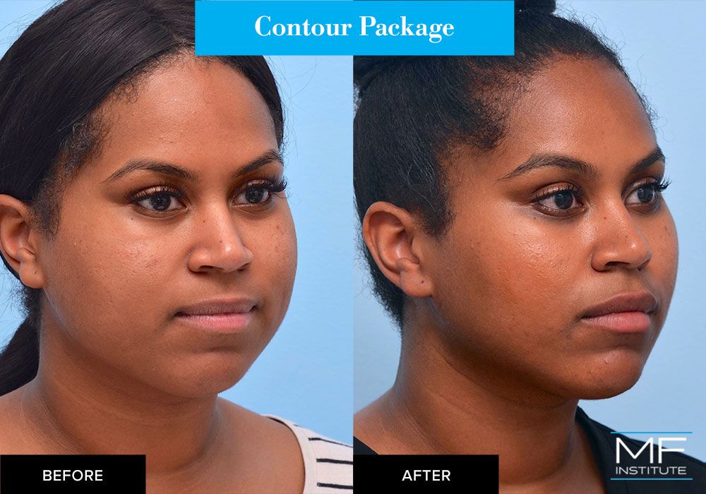 woman before and after contour package