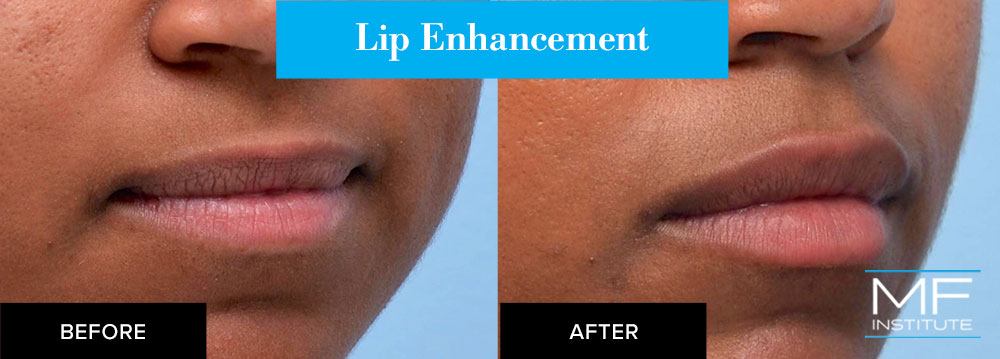woman's lips before and after lip enhancement