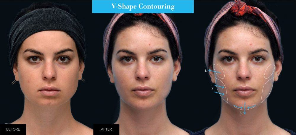 before and after infographic of v-shape contouring on female