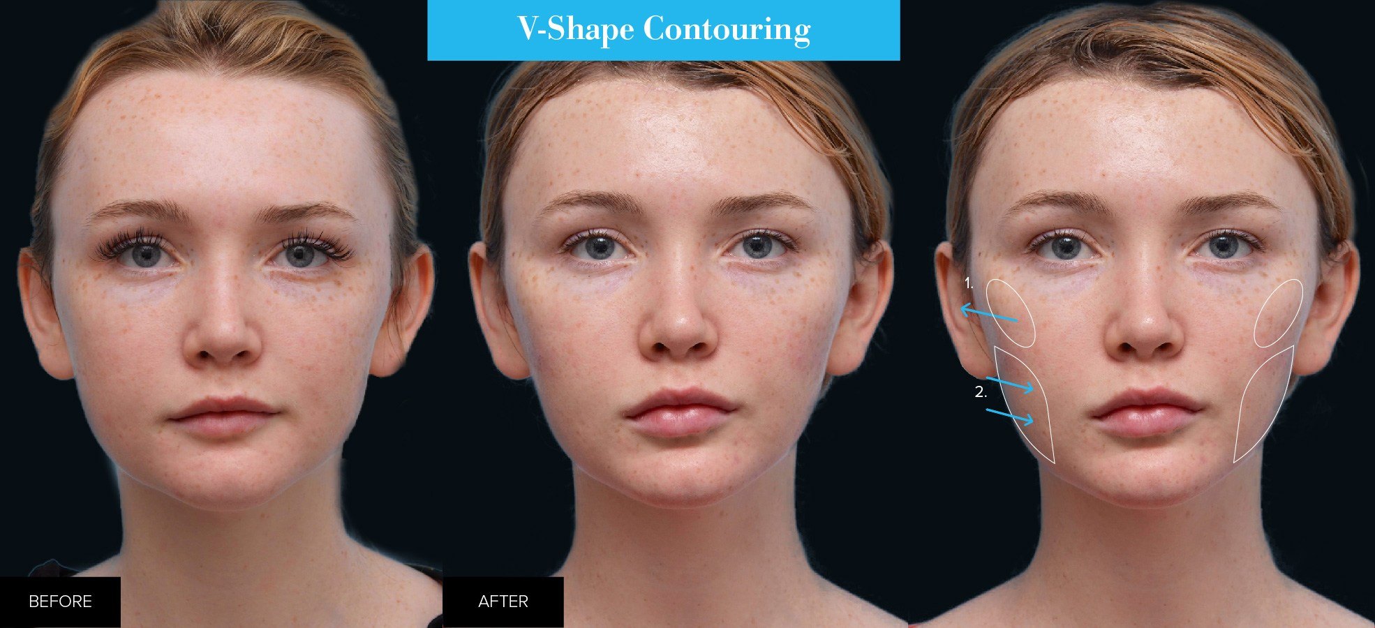 before and after of v-shape contouring