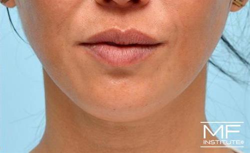 woman's chin with fillers