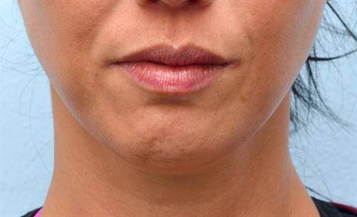 woman's chin before botox fillers