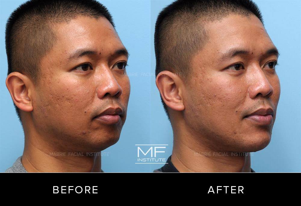Before and after images of chin and jawline filler patient #339