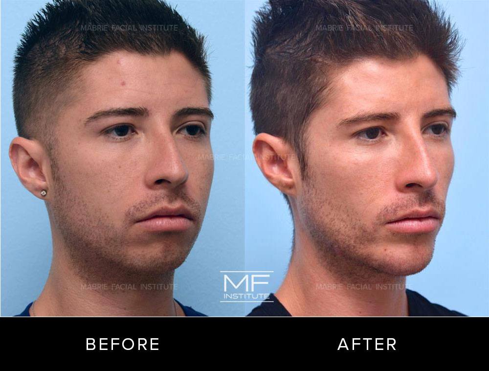 Before and after images of chin and jawline filler patient #496