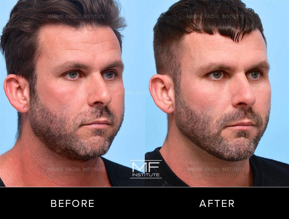 Before and after images of chin and jawline filler patient #640