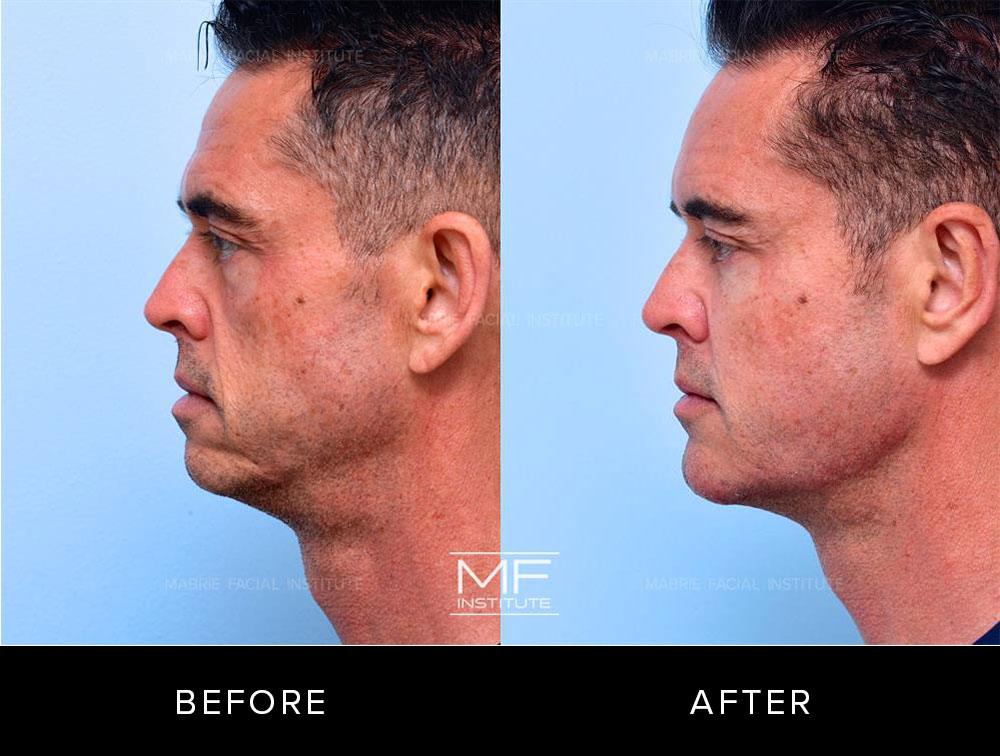 Before and after images of chin and jawline filler patient #645